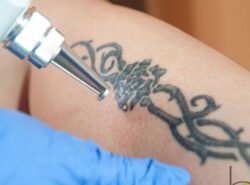 The Science Behind Tattoo Removal